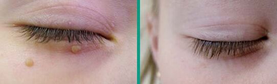 Rapida scomparsa dei papillomi - il risultato dell'uso di Keraderm